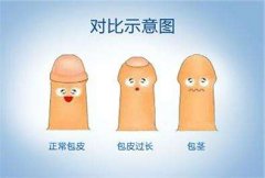 包皮过长会影响性生活吗