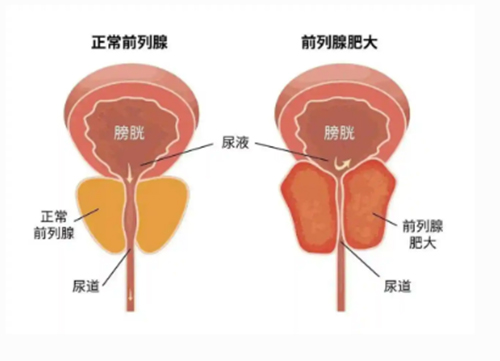 <b>前列腺肥大怎么治疗</b>
