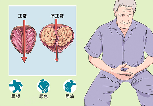 <b>前列腺钙化灶是怎么回事严重吗</b>