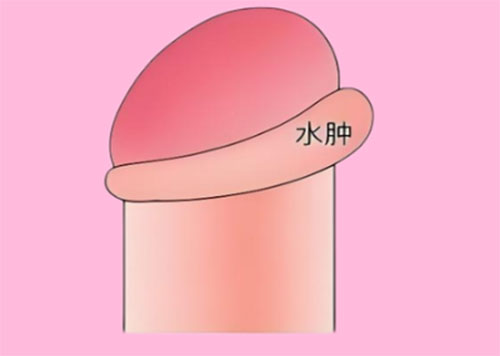 <b>包皮肿了是什么原因</b>